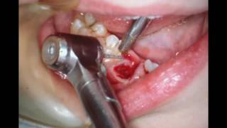 Orthodontic Slicing of decidious teeth with pulpotomy [upl. by Eiduj211]