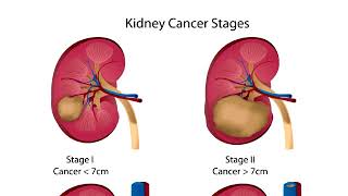Diagnose Nierenkrebs [upl. by Deeyn]