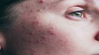 TRATAMENTO DE ACNE COM ANTIBIÓTICOS ORAIS [upl. by Suqram580]