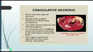 Necrosis  Pathology Learning [upl. by Colet]