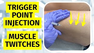 Are Infraspinatus Trigger Points Causing You Pain [upl. by Adikam]