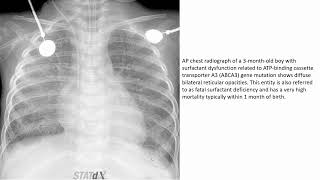 Childhood Interstitial Lung Disease [upl. by Tenom]