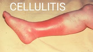 Cellulitis Skin InfectionCellulitisCauses SymptomsDiagnosisTreatmentPrevention Complications [upl. by Llahsram444]