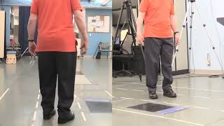 Functional Ambulation Patient With Orthoses [upl. by Nanfa209]