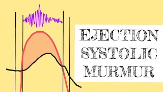 Ejection systolic murmur [upl. by Lesli]