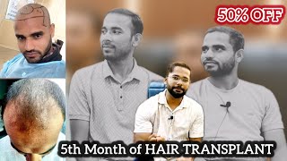 Two Patient 5 Month Amazing Hair Transplant Result in Delhi [upl. by Theurer]