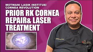 Topographic Guided Ablation For Corneal RK Radial Keratotomy Repair [upl. by Apgar]