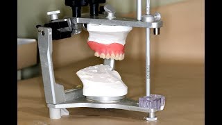 Clinical Remount of Complete Dentures [upl. by Schwartz]