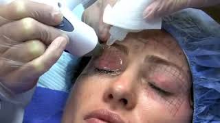 Thermage NYC Treatment by NY Cosmetic Dermatologist [upl. by Anailuig]