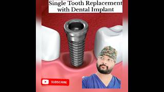 Dental Implants for SingleMultiple teeth replacementyt shorts dentist Prosthodontics in Patna [upl. by Winer]