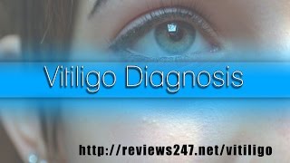 Vitiligo Diagnosis Age [upl. by Block614]