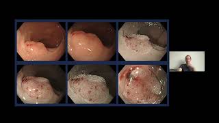 GECHO Fellows Presentation  Assessment of polyps and what to do [upl. by Aehsila]