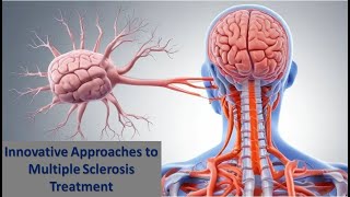 Innovative Approaches to Multiple Sclerosis Treatment [upl. by Olbap]