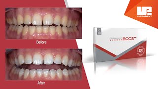 What to Expect with Opalescence Boost Professional Teeth Whitening [upl. by Aldo]