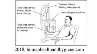 What are Hemodialysis and Peritoneal Dialysis [upl. by Eniarol]