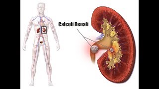 Soffri di calcoli renali Evita questi alimenti per non formare calcoli renaliVideo informativo [upl. by Ahsenad]