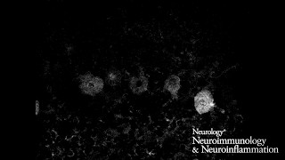 Voltagegated calcium channel autoimmune cerebellar degeneration 22 [upl. by Chan]