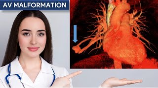 Radiographic Features of Arteriovenous Malformation [upl. by Hallette]