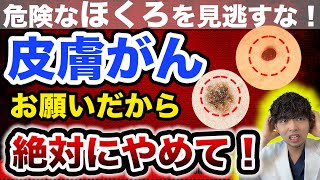 【必ずチェックして】見逃すと後悔する皮膚がんのSOSサイン５選【医師解説】 [upl. by Chris952]