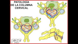 Patología de la columna cervical [upl. by Zarla934]