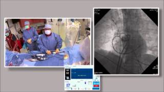 Part 5B of 6 Cryoballoon ablation for Atrial Fibrillation by Wilber Su [upl. by Eletnahc]