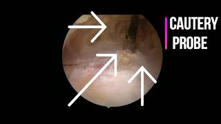 Hip Bursitis Surgery  Arthroscopic removal of hip bursitis [upl. by Esilrac]