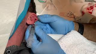 Auricular hematoma aspiration part 4 [upl. by Richard]