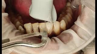 Teeth cleaning removing tough smoking stains [upl. by Kask]