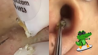 Ultimate ASMR Pimple Popping Compilation  Blackhead amp Cyst Extraction for Maximum Relaxation [upl. by Eilrak689]