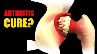 Arthritis Youre Treating It Wrong See How to Actually Repair Cartilage [upl. by Itnuahsa]