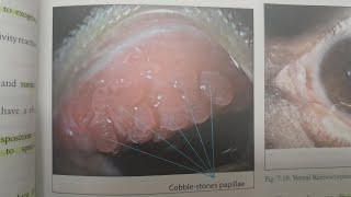 Vernal Keratoconjunctivitis  EYE [upl. by Audley496]