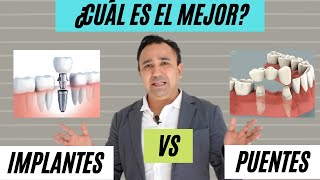 ¿Perdiste un diente  Implantes vs puentes  ¿Cuál es la mejor opción [upl. by Aruon]