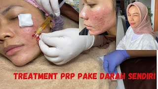 Treatment PRP untuk bopeng [upl. by Yrbua]