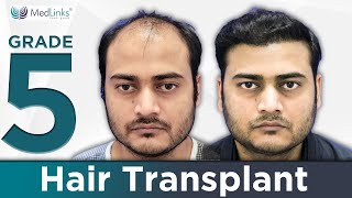 Hair Transplant Before amp After  6 Month Results  3500 Grafts transplanted in Front and Hairline [upl. by Arathorn]