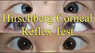 Hirschberg Corneal Reflex Test Principles and Procedure [upl. by Georg]