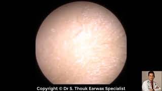 Top Biggest Ear Wax Removal 121  Ear wax Extraction  Dr S Thouk Earwax Specialist [upl. by Fortunato649]