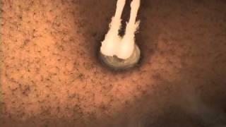 NonSurgical Keloid Treatment with Cryotherapy [upl. by Nwahsauq]