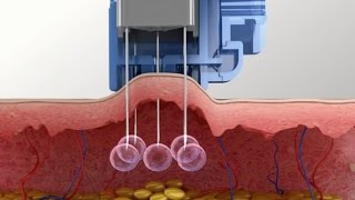 Meso Injector system for Mesotherapy Injection [upl. by Cassey558]