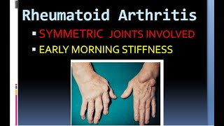 Pathology 860 Rheumatoid Arthritis Hladr4 hladr1 ankylosis pannus rheumatoid factor [upl. by Ace279]