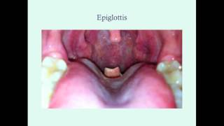 Epiglottitis  CRASH Medical Review Series [upl. by Villiers]