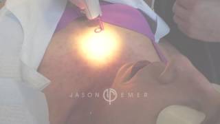 Telangiectasia Spider Angioma  VBeam Pulsed Dye Laser  Beverly Hills California [upl. by Anavahs]