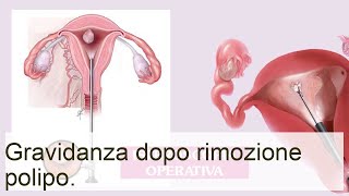 Gravidanza dopo la rimozione del polipo  Lezioni per le mamme [upl. by Bogusz553]