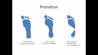 What Is Overpronation [upl. by Moran]