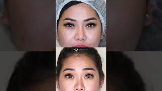 Botox Allergan allergan botulinumtoxin botox antiwrinkle antiagingtreatment skinevo [upl. by Brill282]