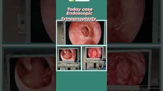 13 November 2024 Large EAR 👂 DRUM perforation repairtympanoplastyendoscopic ear 👂 surgery [upl. by Lajes]