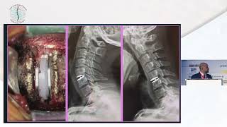 Anterior vs Posterior CSpine Approaches Complications amp Outcomes by Dr Ali Baaj [upl. by Iadam297]