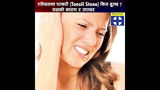 Tonsil stone Dr Sriti Manandhar ENTSurgeon rhinologist endoscopicsinussurgeon kathmandunepal [upl. by Aytnahs]