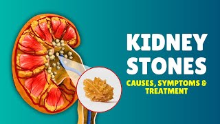 What are Kidney Stones Causes Signs and Symptoms Diagnosis amp Treatment [upl. by Sheilah]