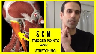 Dizziness headaches and neck pain from SCM trigger points [upl. by Hayott]