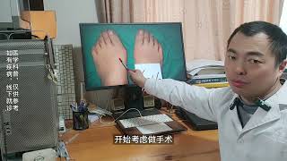 hallux valgus 拇趾外翻后续会发展到怎么样？拇外翻的发展及变化 [upl. by Ylehsa]